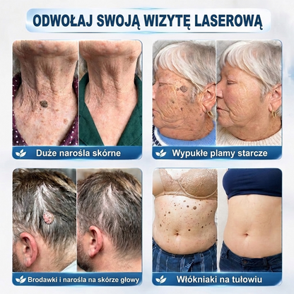 𝐎𝐟𝐢𝐜𝐣𝐚𝐥𝐧𝐲 𝐬𝐤𝐥𝐞𝐩 𝐦𝐚𝐫𝐤𝐢 | ✅️ Trilumia® 7-dniowy preparat na narośle skórne i przebarwienia (bezbolesny aplikator roll-on, bez blizn) 😍
