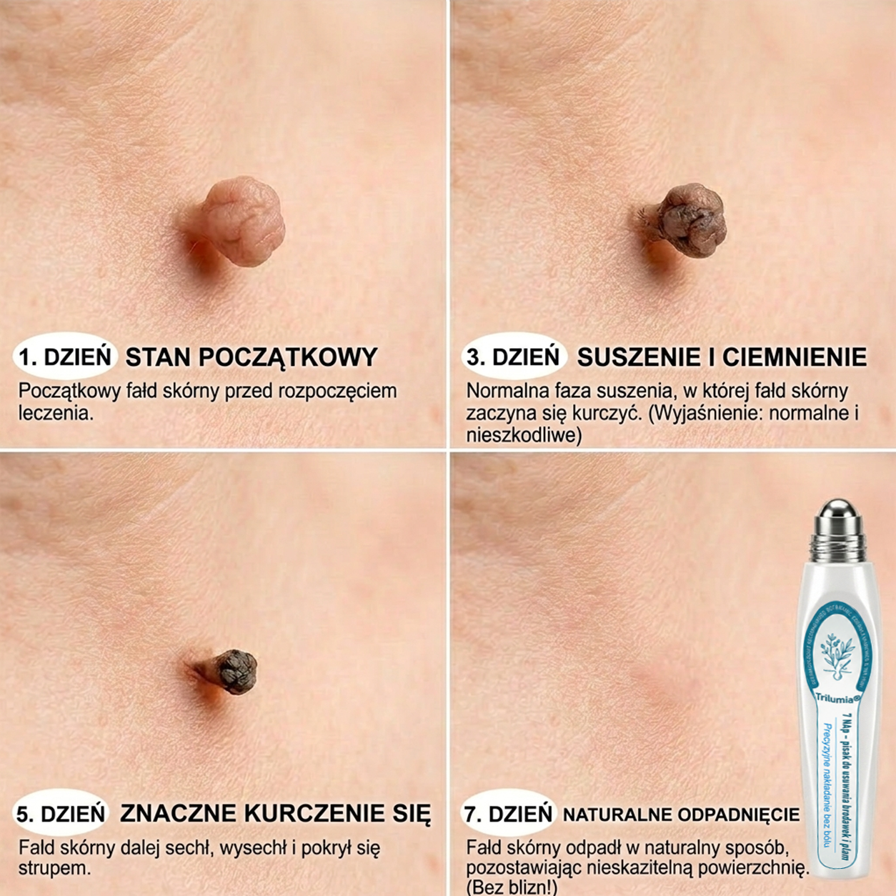 𝐎𝐟𝐢𝐜𝐣𝐚𝐥𝐧𝐲 𝐬𝐤𝐥𝐞𝐩 𝐦𝐚𝐫𝐤𝐢 | ✅️ Trilumia® 7-dniowy preparat na narośle skórne i przebarwienia (bezbolesny aplikator roll-on, bez blizn) 😍